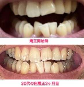 30代大人 歯列矯正 3ヶ月目 ビフォーアフター デコボコ(叢生)歯並び